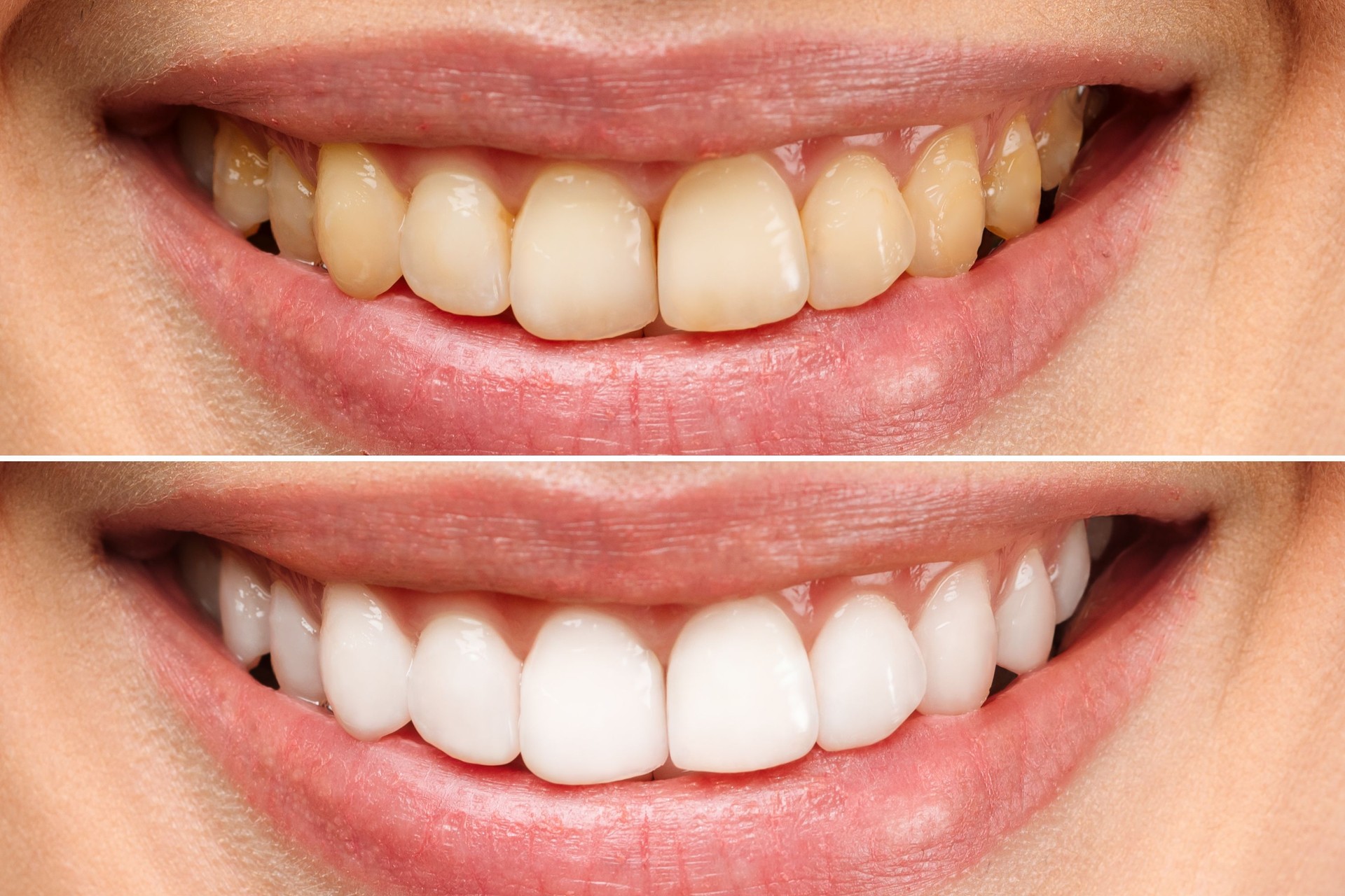 woman teeth before and after whitening. Over white background. Dental clinic patient. Image symbolizes oral care dentistry, stomatology